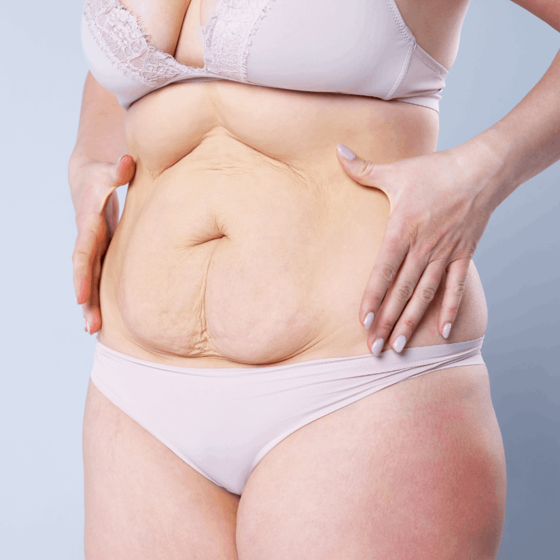 Cirurgião Estética Avançada Clínica Abdominoplastia, barriga flácida, retirar pele barriga, São Paulo SP