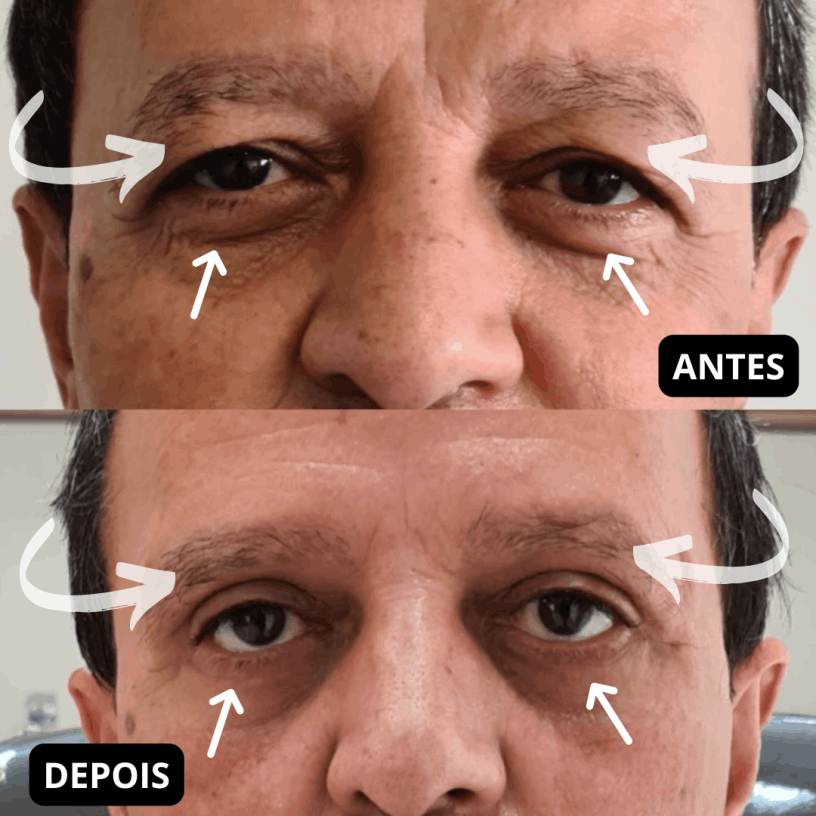 Cirurgião Estética Avançada Clínica Blefaroplastia São Paulo SP