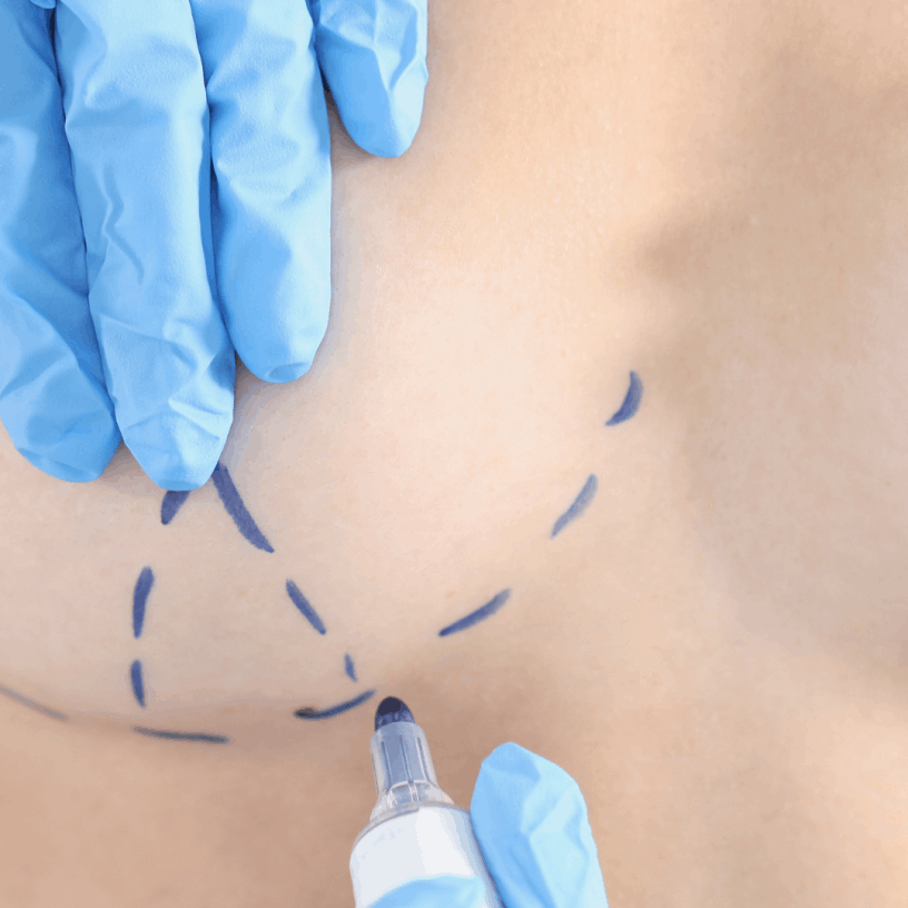 Cirurgião Estética Avançada Clínica Mastopexia, firmeza para seios caídos, São Paulo SP